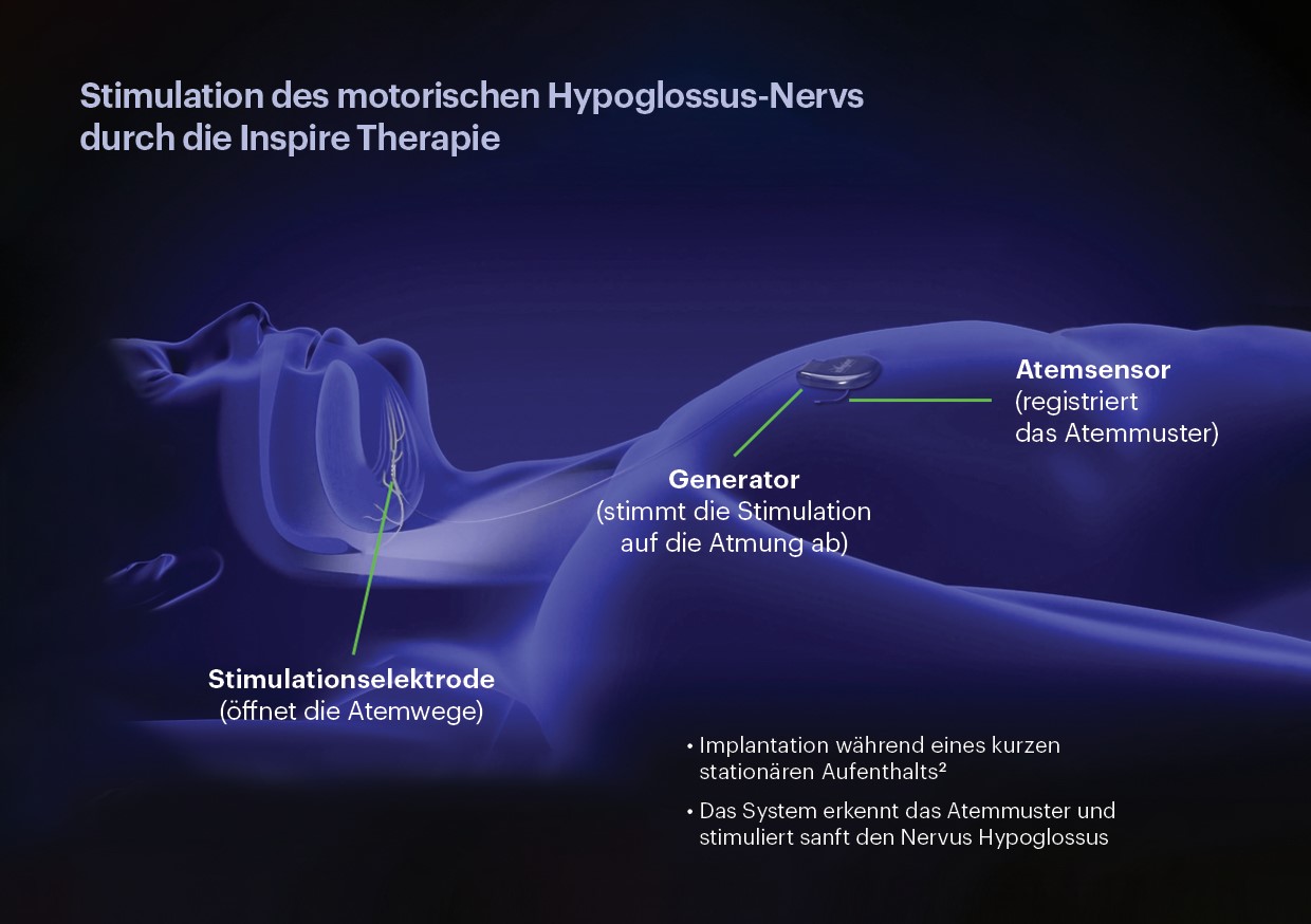 Zungenschrittmacher gegen Schlafapnoe | Wir für Gesundheit